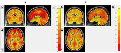 Brain Entropy Study on Obsessive-Compulsive Disorder Using Resting-State fMRI